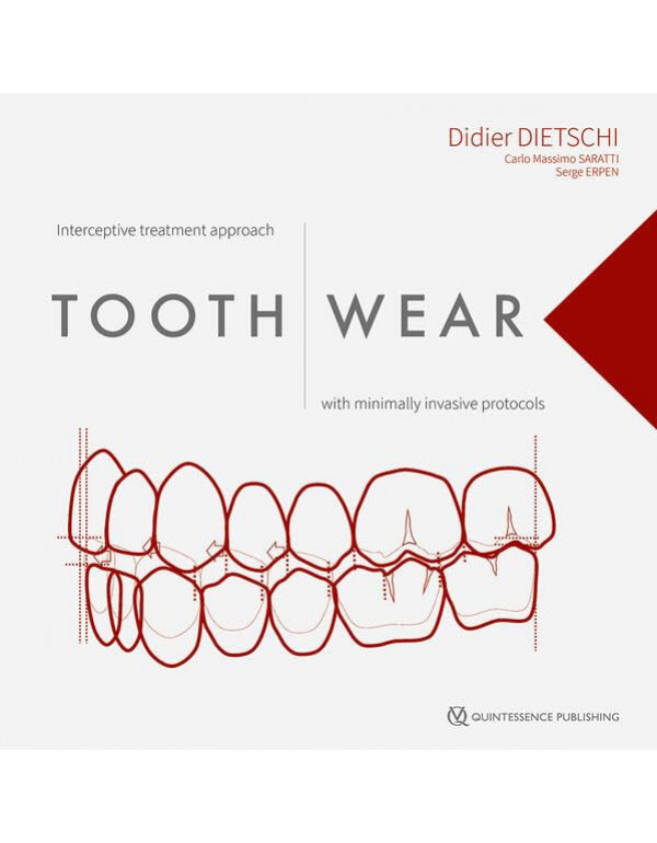 Tooth Wear: Interceptive Treatment Approach With M...